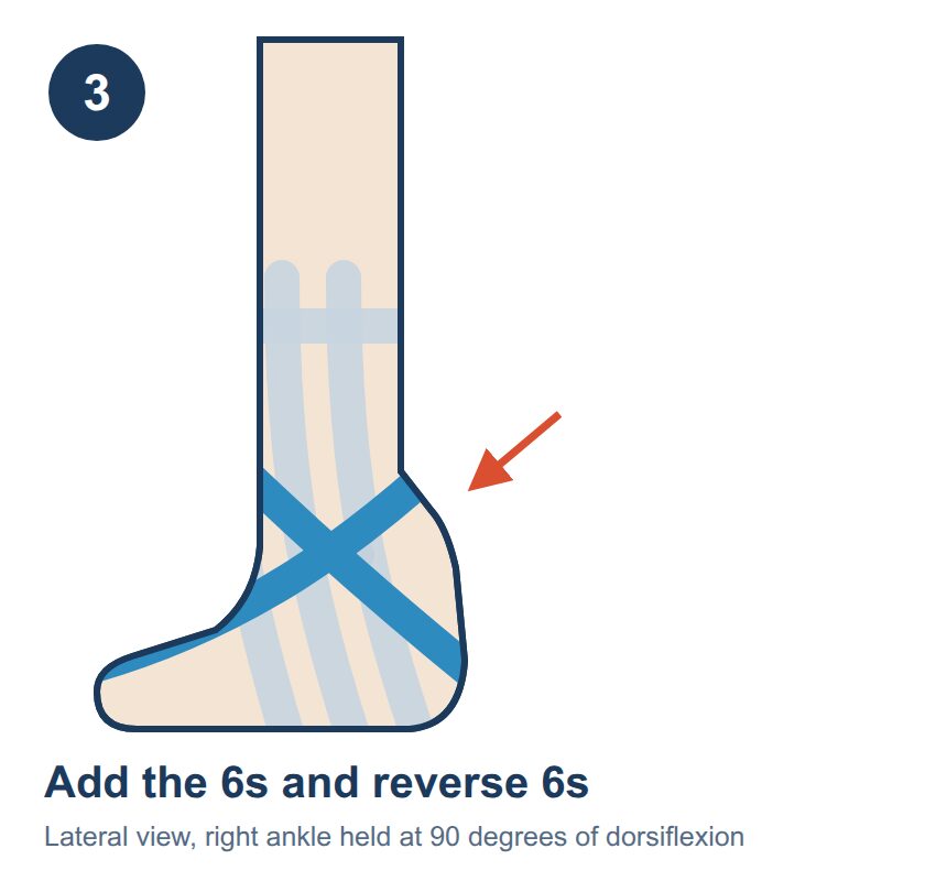 Diagram of step 3, tape running diagonally across the ankle in one direction and then mirrored in the other