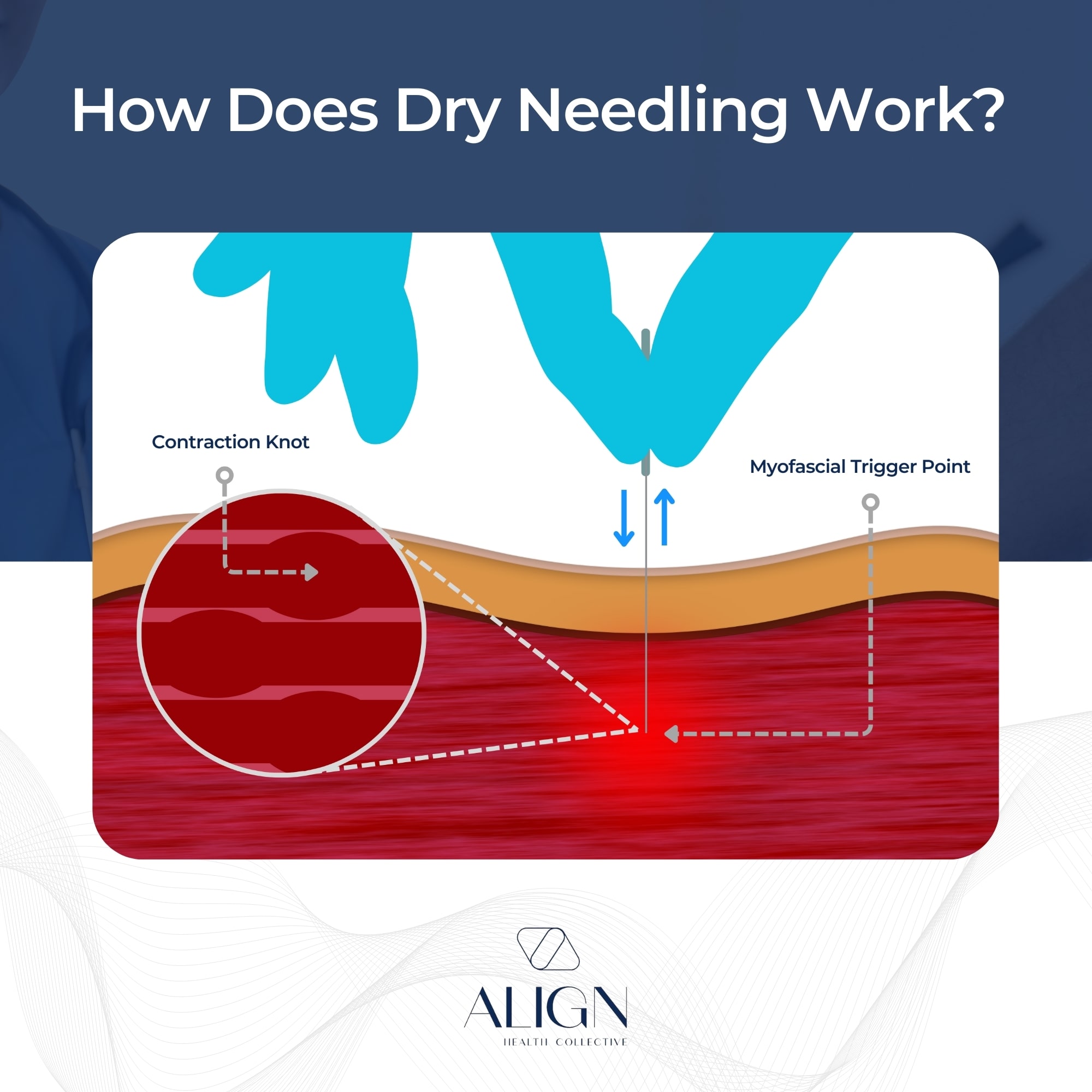 How does Dry Needling Help?