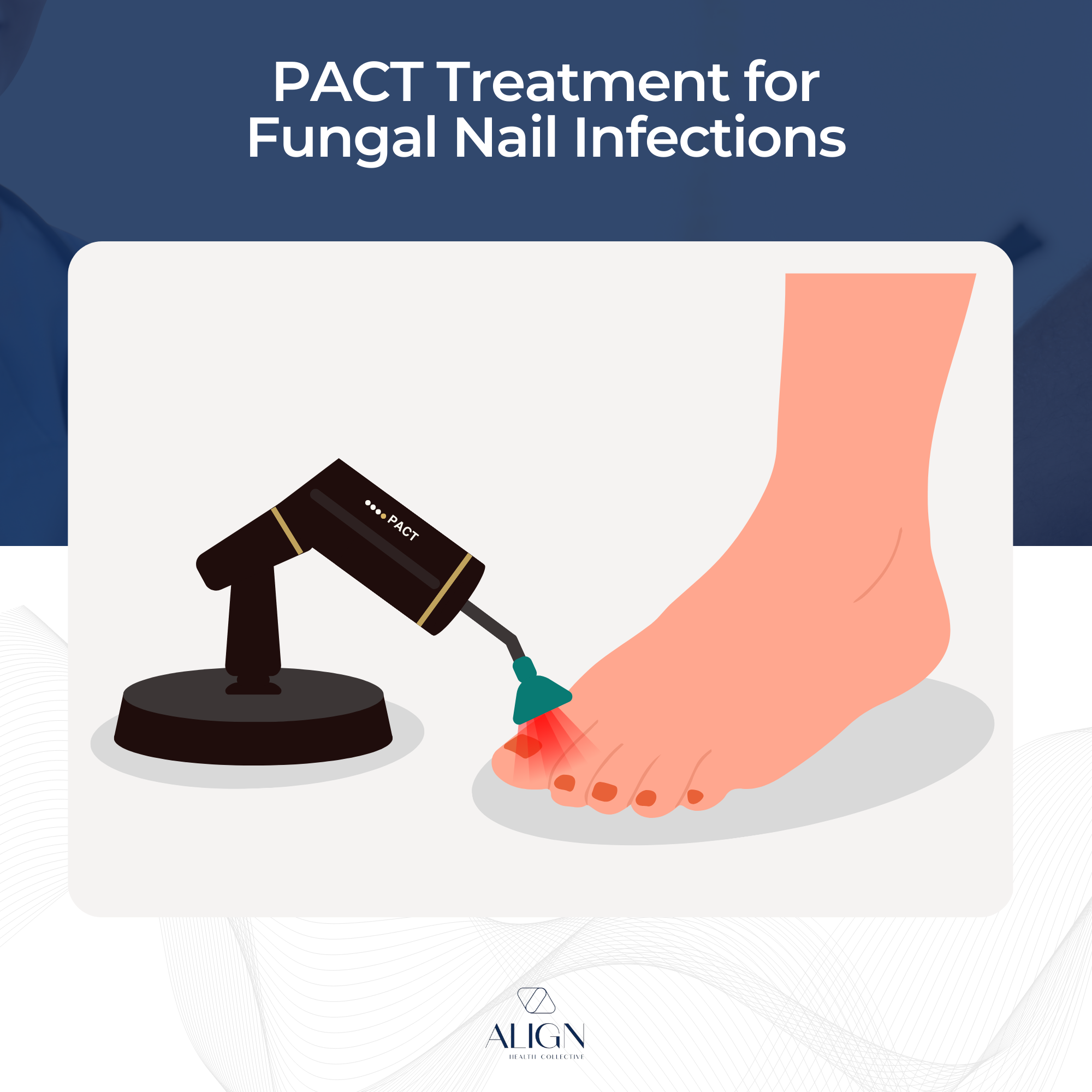 Pact Fungal Nail Treatment in Brisbane