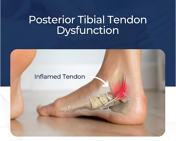 Inflamed Tendon