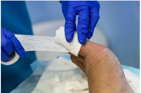 Surgical Treatment for Ingrown Toenails