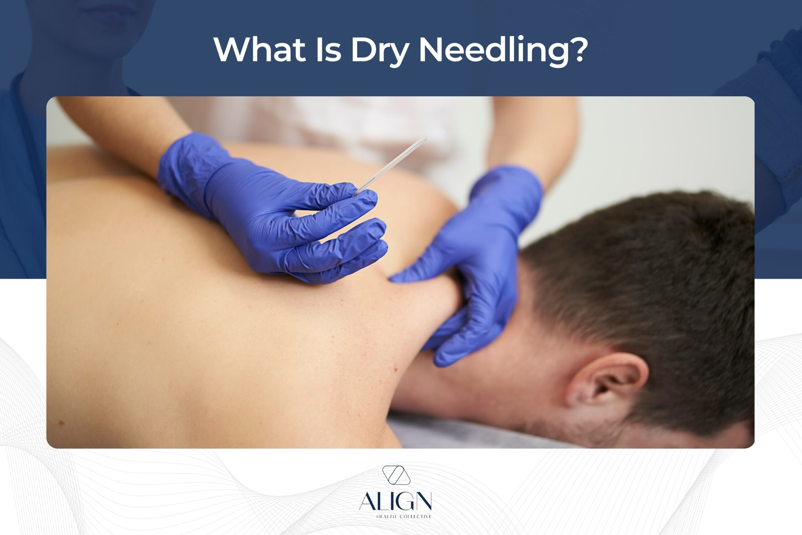 What is Dry Needling?
