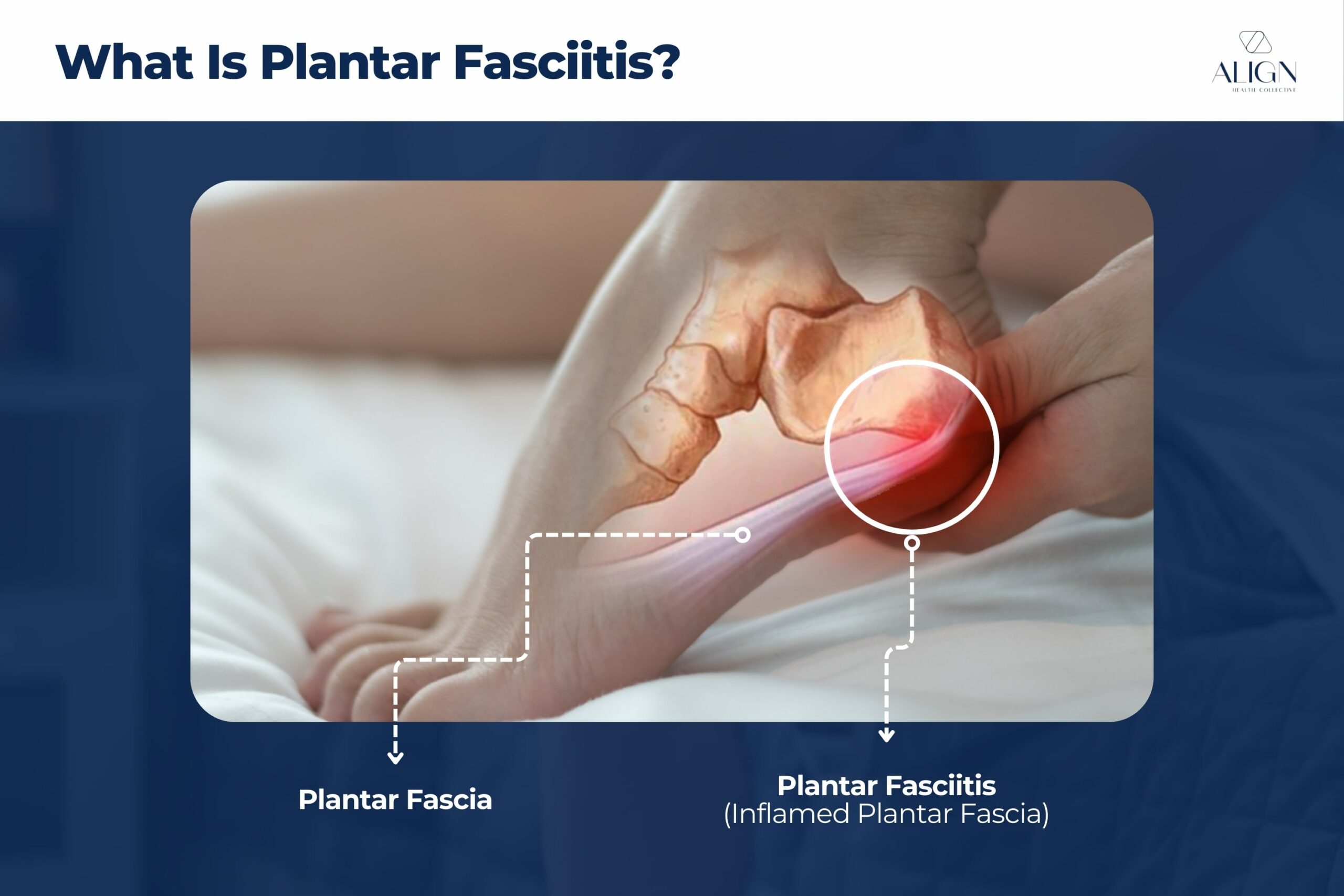 What is Plantar Fasciitis? 